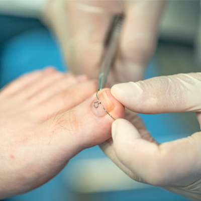 A órteses para correção das unhas são dispositivos utilizados por podólogos e profissionais de saúde para ajudar a tratar e corrigir problemas nas unhas, como unhas encravadas ou deformidades.​